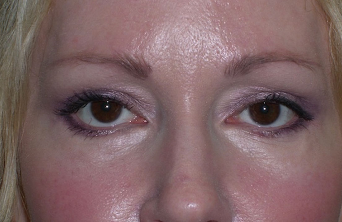 After clinical photograph, eyelids procedure