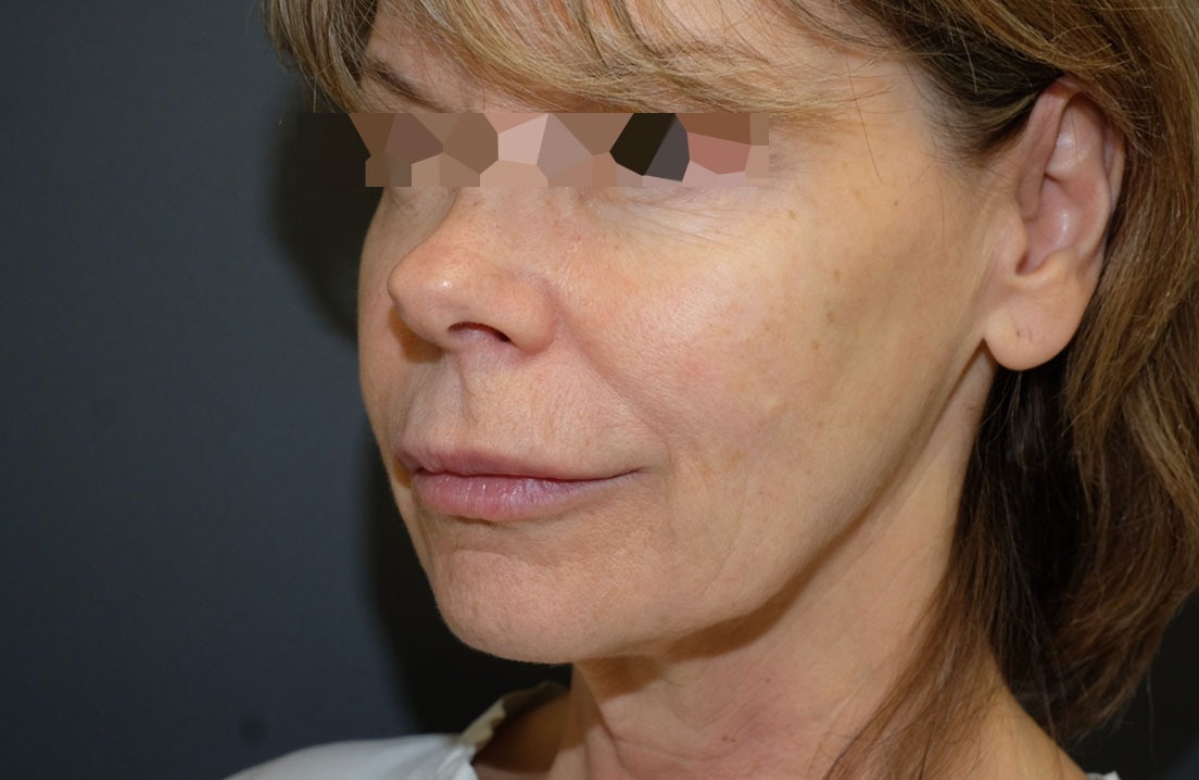 Before clinical photograph, face procedure
