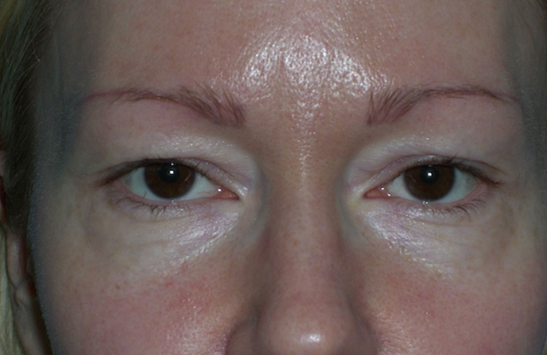 Before clinical photograph, eyelids procedure