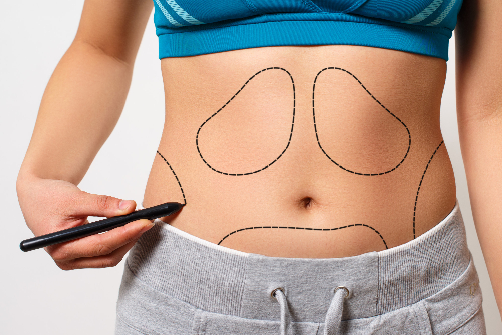 Clinical photograph showing liposuction markings on a patient's abdomen