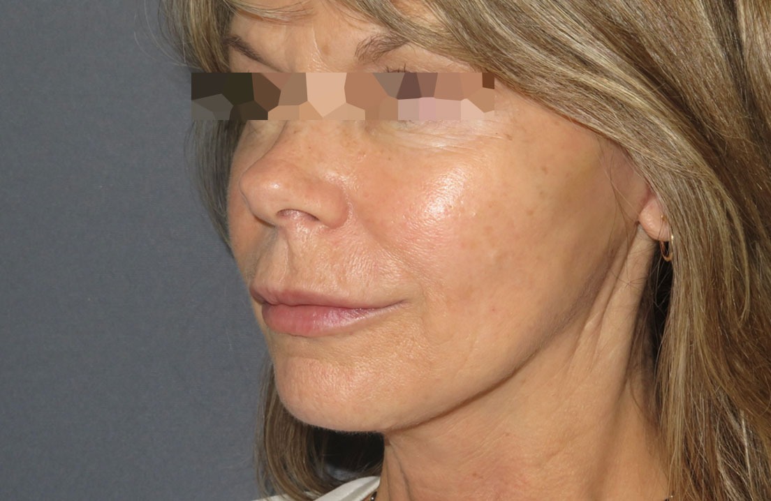 After clinical photograph, face procedure