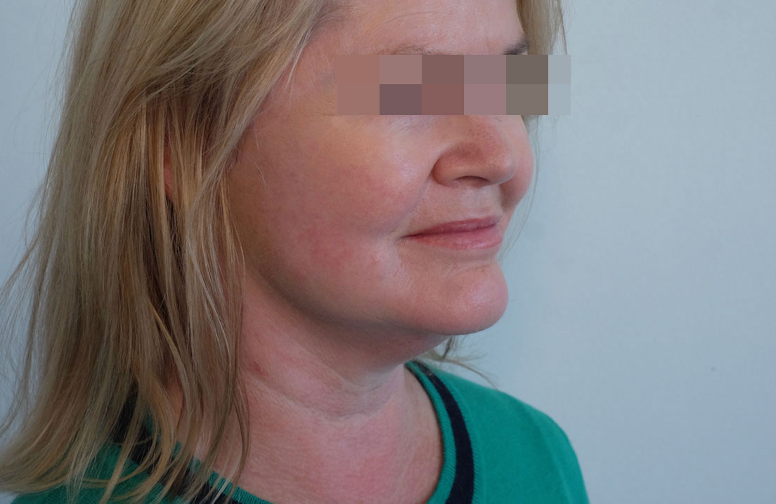 Clinical photograph of a face and neck lift patient after her procedure